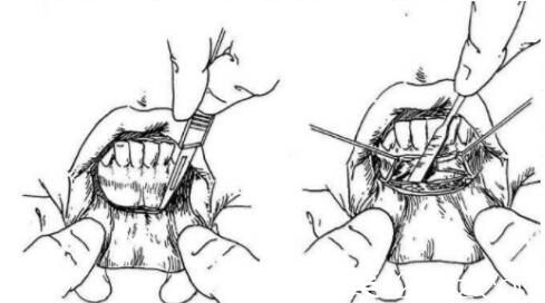 硅膠墊下巴手術(shù)原理