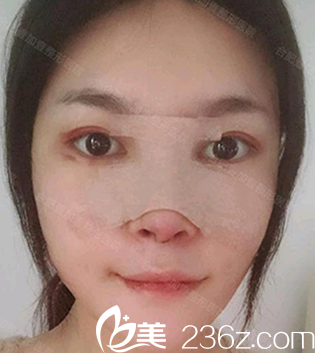 找合肥壹加壹甘泉涌做肋軟骨鼻綜合術(shù)后第1天照片