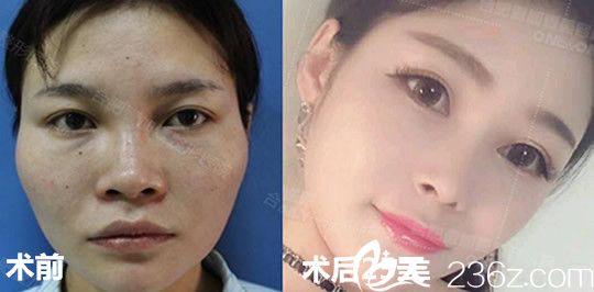 肋軟骨隆鼻+玻尿酸填充太陽穴前后效果對比圖