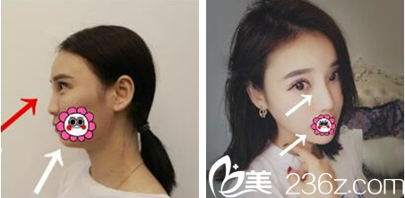 張<!--<i data=20240703-sp></i>-->玻尿酸隆鼻墊下巴 張<!--<i data=20240703-sp></i>-->玻尿酸隆鼻墊下巴