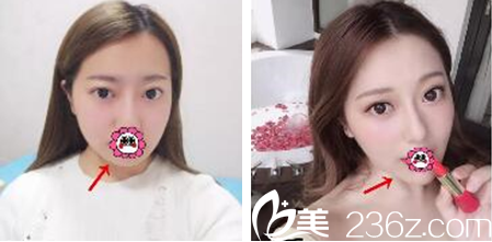 <!--<i data=20240703-sp></i>-->汪國(guó)應(yīng)玻尿酸墊下巴案例 <!--<i data=20240703-sp></i>-->汪國(guó)應(yīng)玻尿酸墊下巴案例