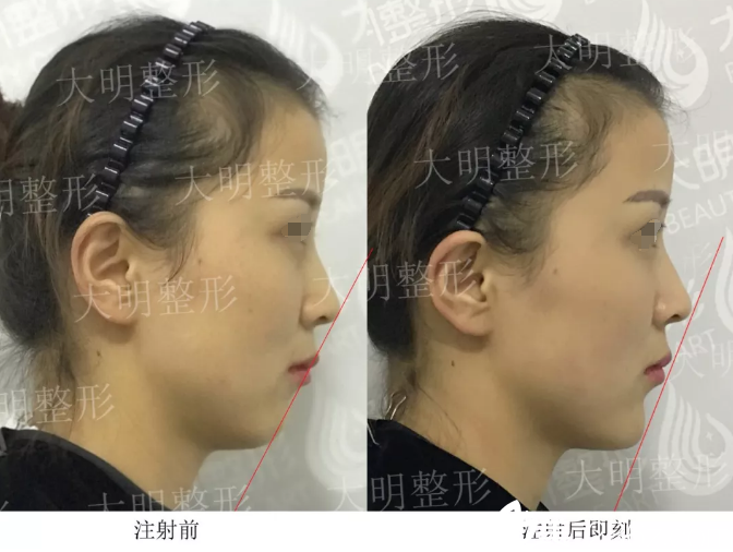 20分鐘注射玻尿酸就改善了20多年的塌下巴 連云港大明員工親證張培鑒院長微整效果