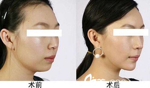 注射完瘦臉案例