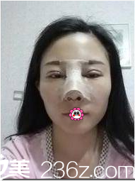 北京京韓做全切雙眼皮假體隆鼻第3天樣子