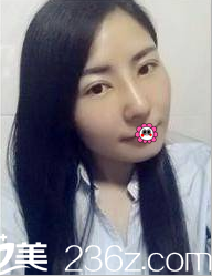 北京京韓張振給我做雙眼皮隆鼻第35天效果