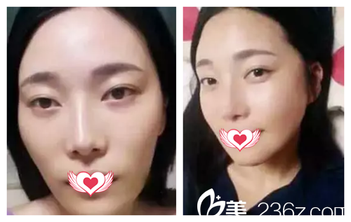 劉建剛主任注射玻尿酸案例 劉建剛主任注射玻尿酸案例