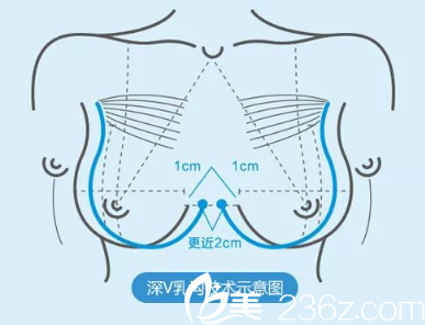重慶時光In-Bra完美豐胸術(shù) 重慶時光In-Bra完美豐胸術(shù)