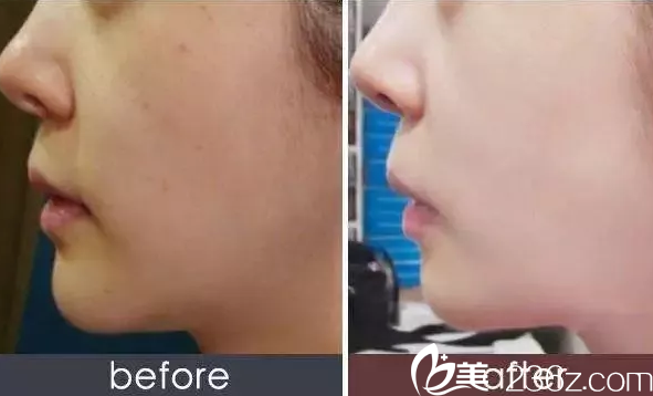 南寧韓星注射案例 南寧韓星注射案例