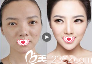 柳龍春醫(yī)生做假體隆下巴案例 柳龍春醫(yī)生做假體隆下巴案例