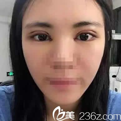 太原華美整形<!--<i data=20240703-sp></i>-->給我做全切雙眼皮和開(kāi)眼角術(shù)后第4天照片 太原華美整形<!--<i data=20240703-sp></i>-->給我做全切雙眼皮和開(kāi)眼角術(shù)后第4天照片