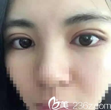 太原華美<!--<i data=20240703-sp></i>-->給我做切開(kāi)雙眼皮加開(kāi)眼角術(shù)后7天拆線照片 太原華美<!--<i data=20240703-sp></i>-->給我做切開(kāi)雙眼皮加開(kāi)眼角術(shù)后7天拆線照片