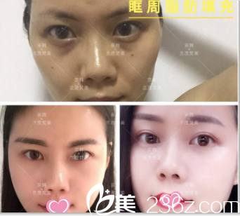 北京京韓喬愛(ài)軍眶周脂肪填充案例
