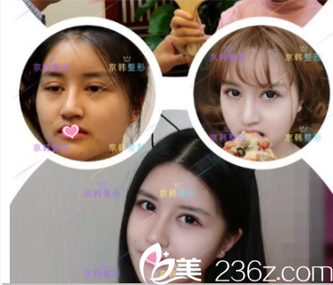 北京京韓張振眼修復(fù)案例