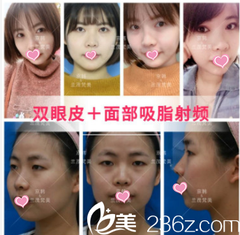 北京京韓張振雙眼皮+面部吸脂射頻案例