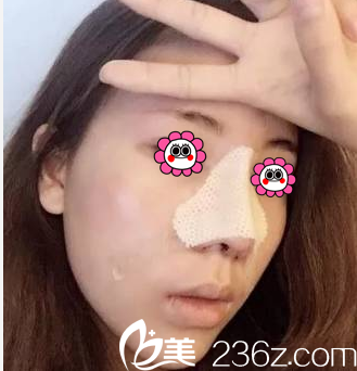 找北京葉子魯禮新做假體鼻綜合第4天樣子