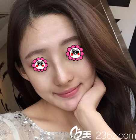 魯禮新給我做鼻子第11天效果