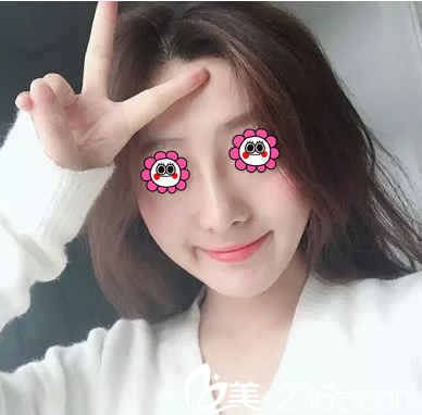 北京葉子假體鼻綜合隆鼻案例