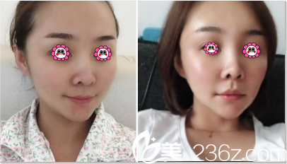 北京美萊宋延剛面部脂肪填充案例