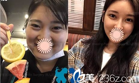 做雙眼皮+顴骨縮小術(shù)+下巴整形手術(shù)后和術(shù)前的對比照