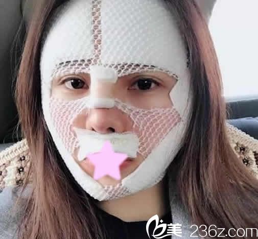 我在運(yùn)城麗都整形做面部自體脂肪填充手術(shù)當(dāng)天