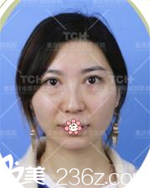 術(shù)前的森女士 術(shù)前的森女士