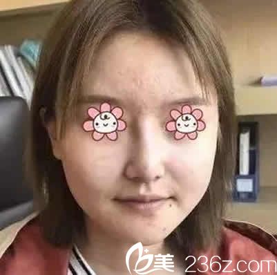 我在運(yùn)城華美整形醫(yī)院做面部線雕前的照片 我在運(yùn)城華美整形醫(yī)院做面部線雕前的照片