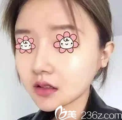 看了一周前在運城華美整形做的面部線雕提升前后對比照片 大家覺得這效果怎么樣