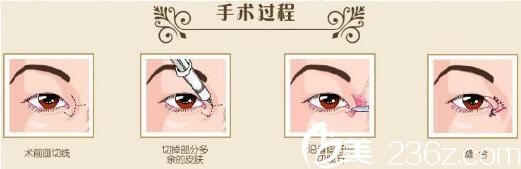 開眼角手術過程