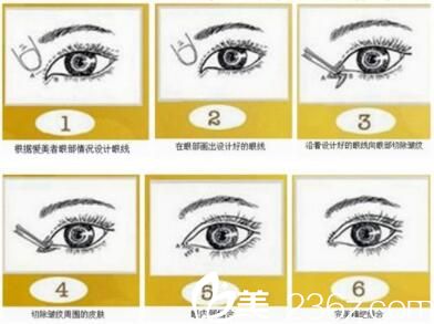 開眼角手術方法2