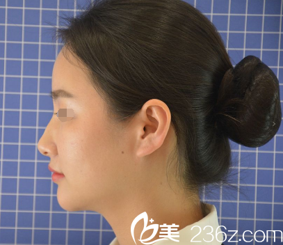 術(shù)前下顎短縮還有印第安紋 術(shù)前下顎短縮還有印第安紋