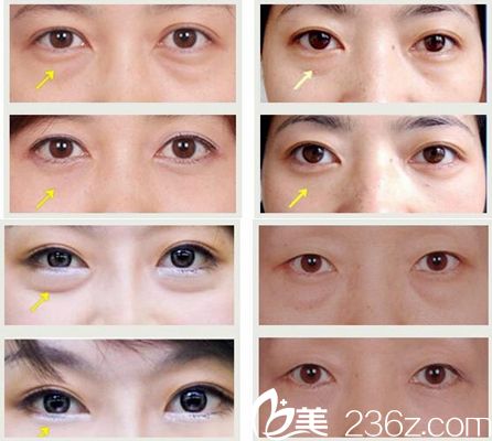 駐馬店美蘭德去眼袋案例