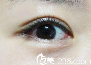 大連做埋線法雙眼皮價(jià)格多少錢？