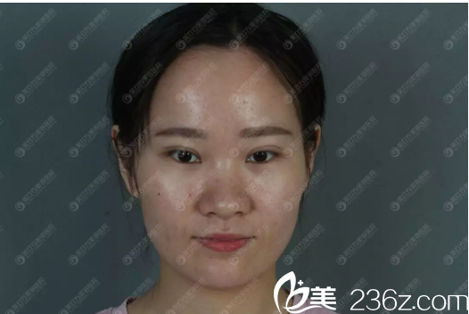 在東莞美立方做隆鼻手術(shù)前 在東莞美立方做隆鼻手術(shù)前