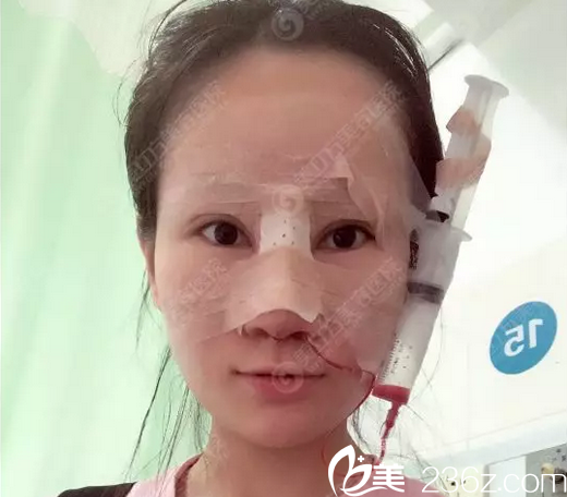 東莞美立方鄭志敏隆鼻手術(shù)天 東莞美立方鄭志敏隆鼻手術(shù)天