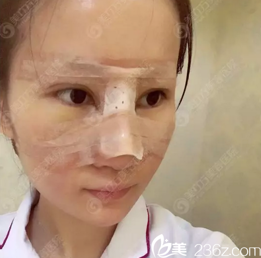 東莞美立方鄭志敏隆鼻手術(shù)第三天 東莞美立方鄭志敏隆鼻手術(shù)第三天