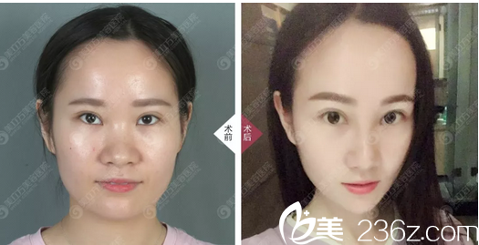 東莞美立方鄭志敏隆鼻案例對(duì)比圖 東莞美立方鄭志敏隆鼻案例對(duì)比圖