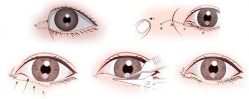 開內(nèi)眼角的手術方式