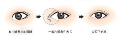 開內(nèi)眼角恢復時間