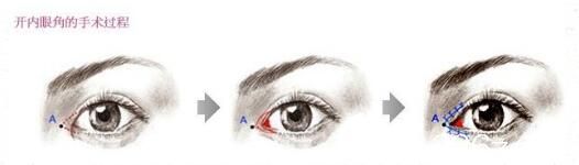 開內(nèi)眼角的手術風險