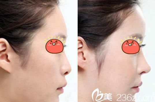 臺(tái)州昊陽(yáng)整形<!--<i data=20240703-sp></i>-->鼻綜合隆鼻