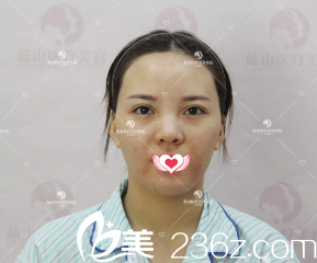 術(shù)前臉大皮膚粗糙 術(shù)前臉大皮膚粗糙