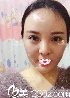 術(shù)后7天面部微腫 術(shù)后7天面部微腫