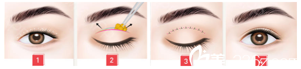 金圣訓(xùn)醫(yī)生切開雙眼皮的手術(shù)方法 金圣訓(xùn)醫(yī)生切開雙眼皮的手術(shù)方法