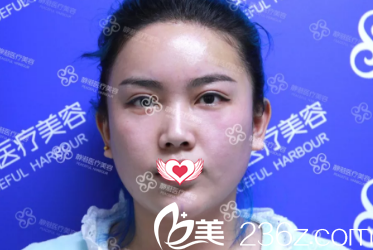 脂肪填充面部5天后微腫 脂肪填充面部5天后微腫