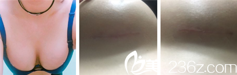 趙镕賢醫(yī)生假體豐胸恢復(fù)10天 趙镕賢醫(yī)生假體豐胸恢復(fù)10天