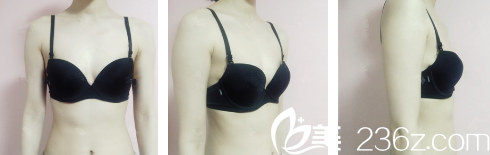 術(shù)前胸部干癟扁平 術(shù)前胸部干癟扁平