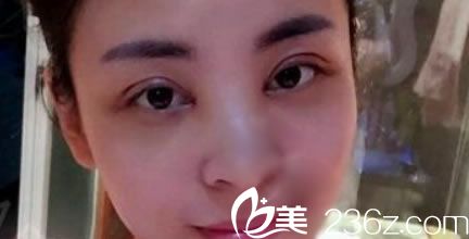 在黃巖昊陽做雙眼皮當(dāng)天效果 在黃巖昊陽做雙眼皮當(dāng)天效果