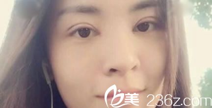 臺州黃巖昊陽整形做雙眼皮效果怎么樣,國慶剛找他割雙眼皮開眼角了