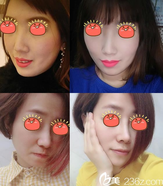 寧波薇琳黃榮案例