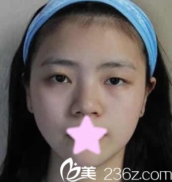 我找長(zhǎng)治悅美整形薛艷峰做眼部綜合整形前照片 我找長(zhǎng)治悅美整形薛艷峰做眼部綜合整形前照片